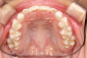 中切歯がやや舌側傾斜しています